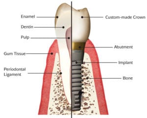 When to Use Form-Stable (Anatomic) Implants - Phase Plastic