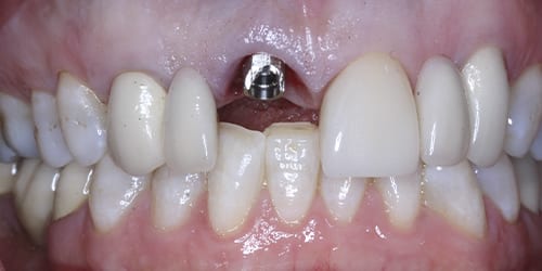 immediate-implant-provisionalization-5