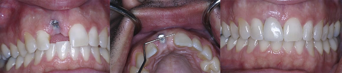 malpositioned-implant-repair