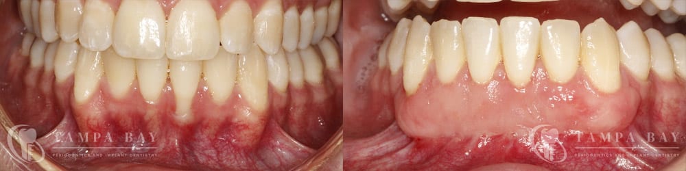 tampa-periodontics-free-gingival-graft-patient-1-1